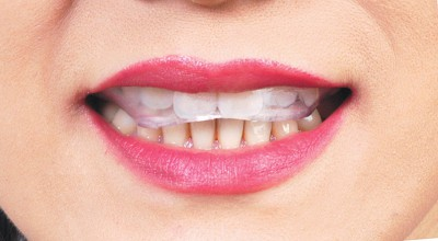 Tìm hiểu về Bệnh nghiến răng, cách chữa bệnh nghiến răng hiệu quả nhất